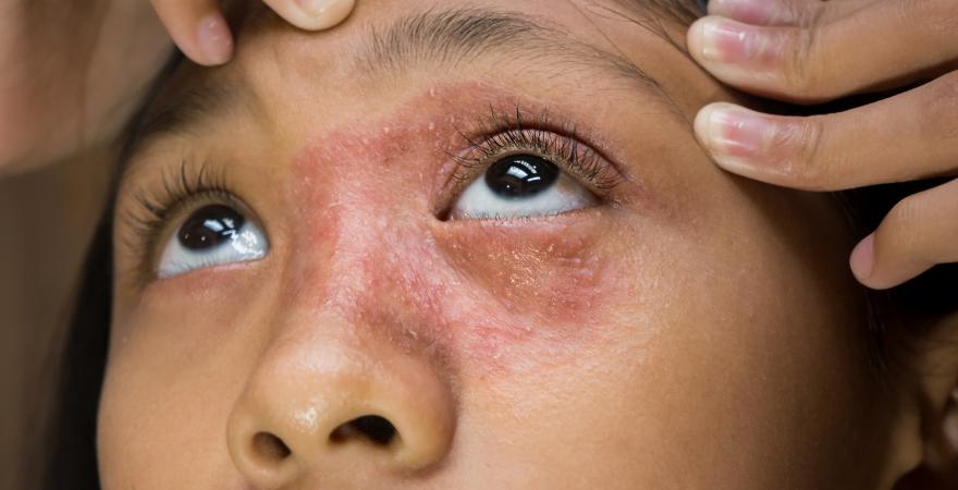 main of A Red Itchy Rash Might Be Due to Contact Dermatitis