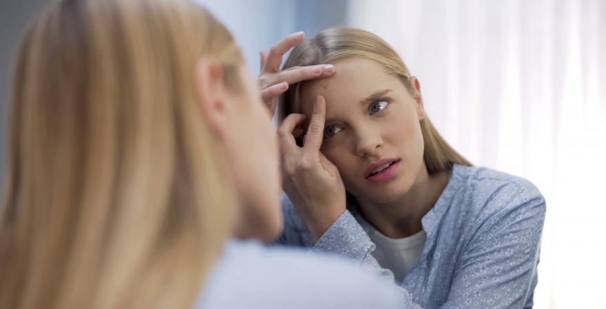 main of Hormonal Acne Can Be Mild or Be Quite Severe