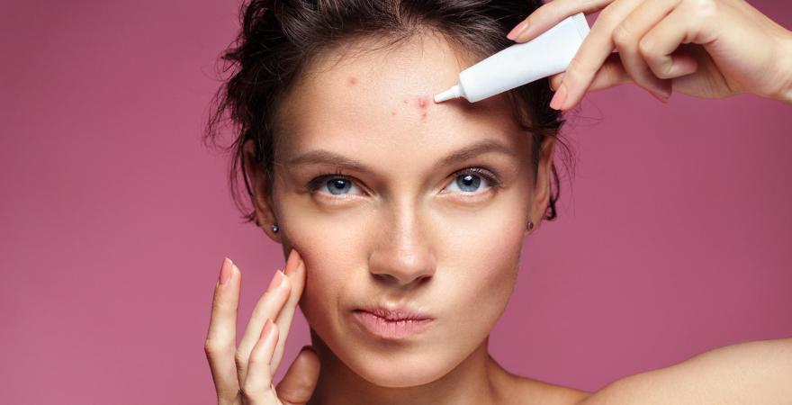 main of Acne Is a Common Problem With a Number of Ways for People To Treat It